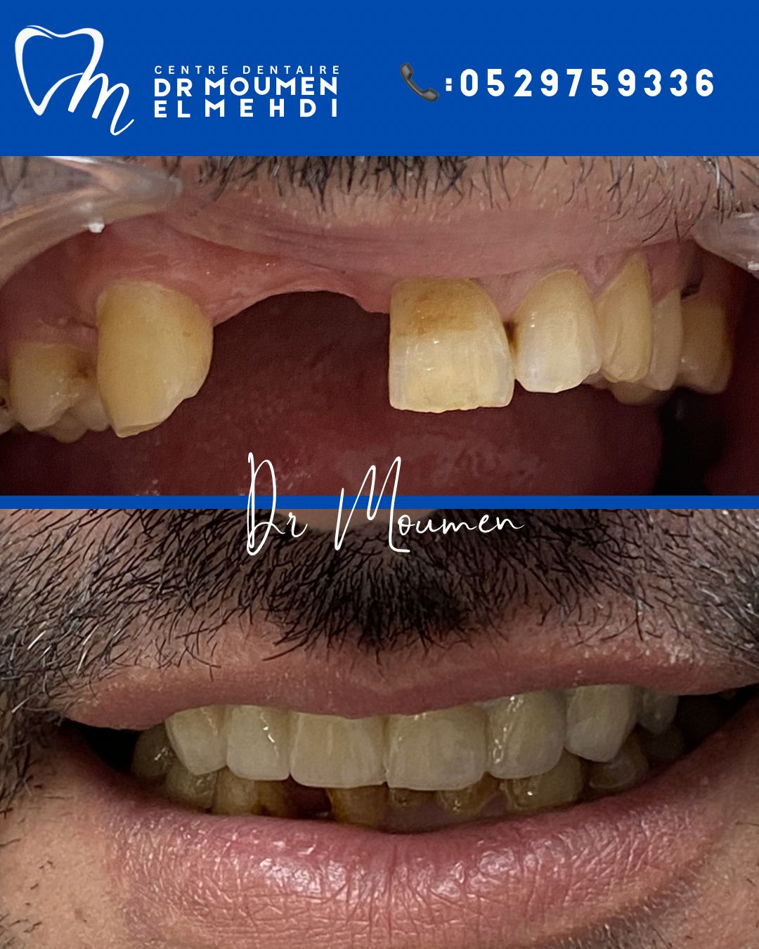 Patiente venue du Royaume-Uni pour un bridge dentaire au Centre Dentaire Moumen à Casablanca